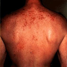 image of Staphylococcal folliculitis