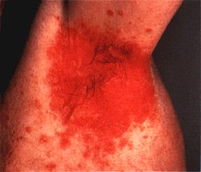 image of Seborrheic dermatitis: axillary