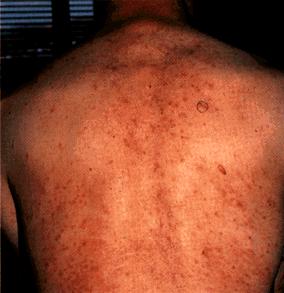 HIV/AIDS Dermatological Images - HIV