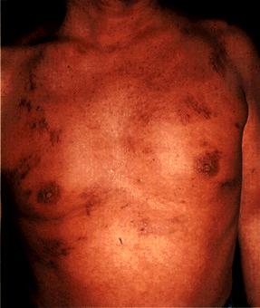 image of Kaposi sarcoma: trunk