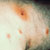 thumbnail image of Staphylococcal furuncles