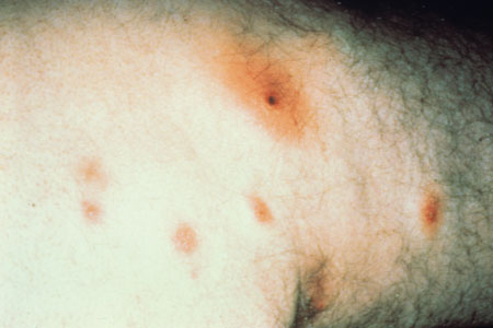 image of Staphylococcal furuncles