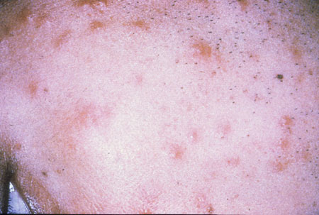 image of Eosinophilic folliculitis
