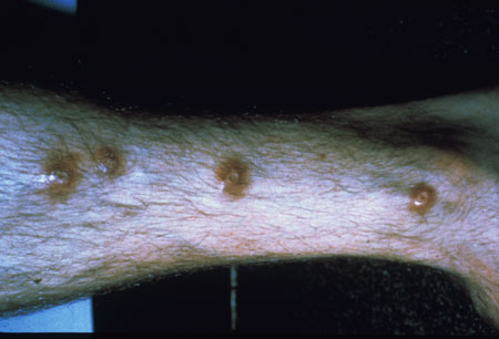 image of Flea bites
