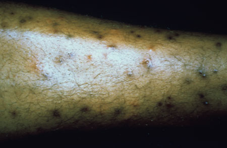 image of Flea bites