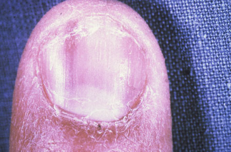 image of Nail changes: caused by zidovudine