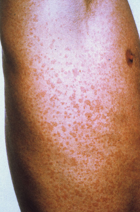 image of Drug rash: caused by trimethroprim-sulfamethoxazole (Septra, Bactrim)