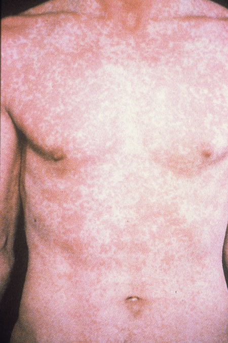 image of Drug rash