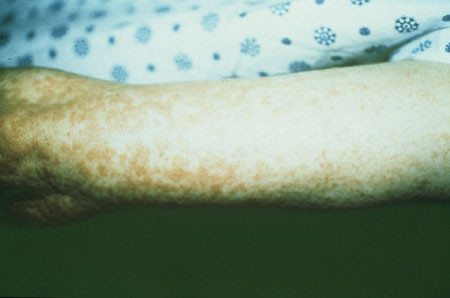 image of Drug rash