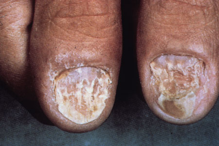 image of Psoriasis: nail changes