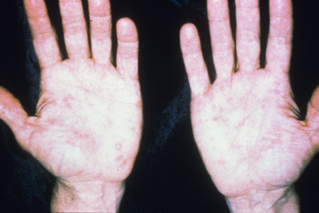 image of Secondary syphilis: palmar rash