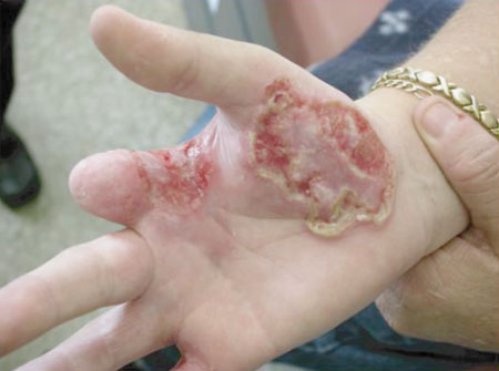 image of Herpes simplex: initially mistaken for staphylococcal infection