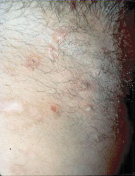 image of Staphylococcal infection: occurring as abscesses
