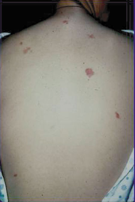 image of Kaposi sarcoma: characteristic presentation in era of potent antiretroviral therapy