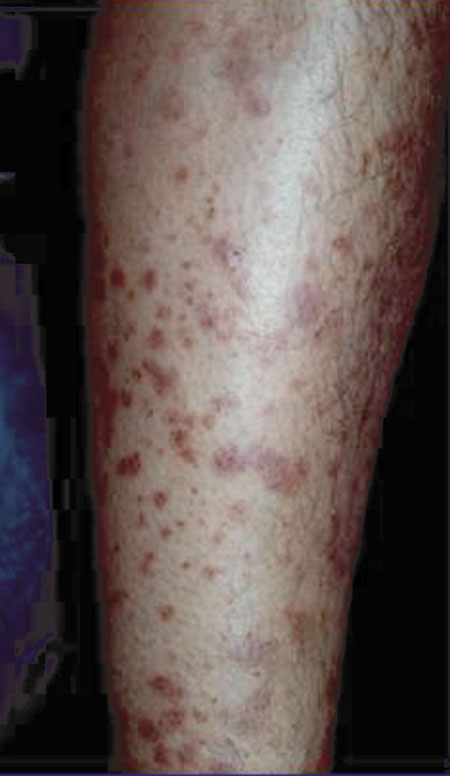 image of Lichen planus: associated with HIV and hepatitis C virus coinfection
