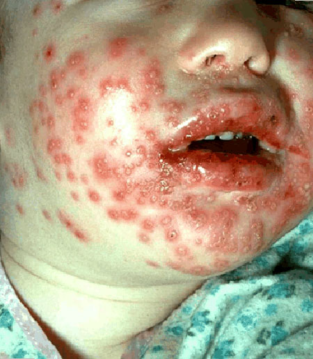 image of Herpes simplex