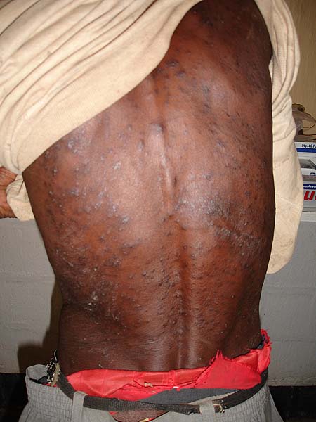 image of Cutaneous manifestations on the back of an HIV-infected man