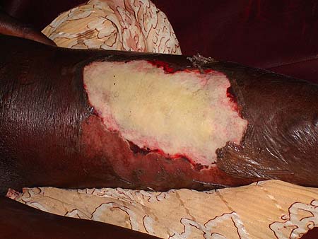 image of Necrotizing fasciitis: in a 35-year-old woman with HIV