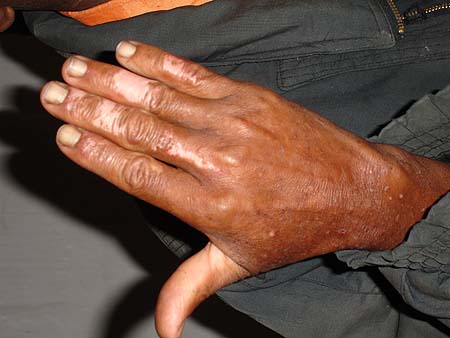 image of Depigmentation (spontaneous): on the fingers of an HIV-infected man