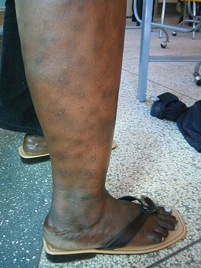 image of Pruritic papular eruption: right lower extremity