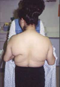 image of Lipodystrophy syndrome (metabolic syndrome)