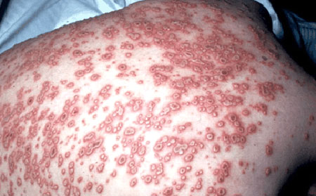 Could rash on back be herpes? - Herpes - MedHelp