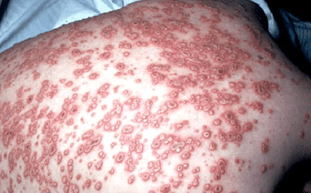 image of Varicella-zoster