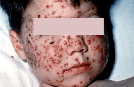 image of Varicella-zoster