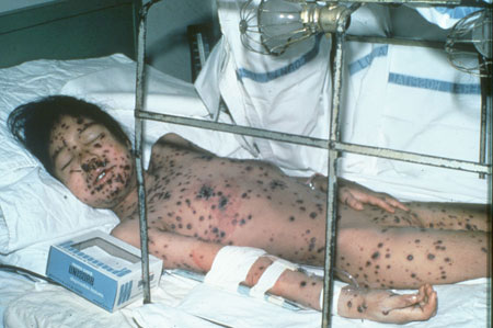 image of Varicella-zoster: hemorrhagic infection