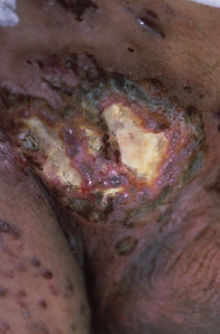 image of Non-Hodgkin lymphoma: arising from Kaposi sarcoma