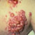 thumbnail image of Non-Hodgkin lymphoma: skin