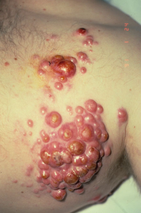image of Non-Hodgkin lymphoma: skin