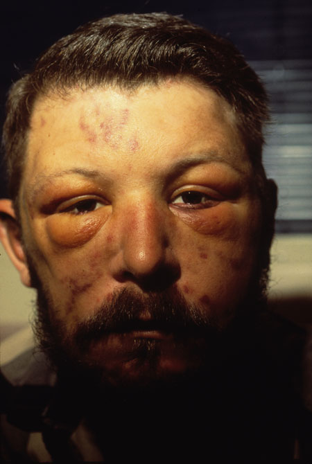 image of Kaposi sarcoma: facial edema