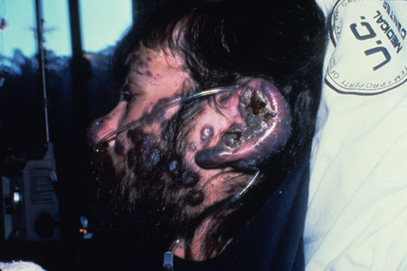 image of Kaposi sarcoma: extensive involvement of face/head