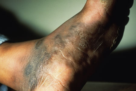 image of Kaposi sarcoma: foot