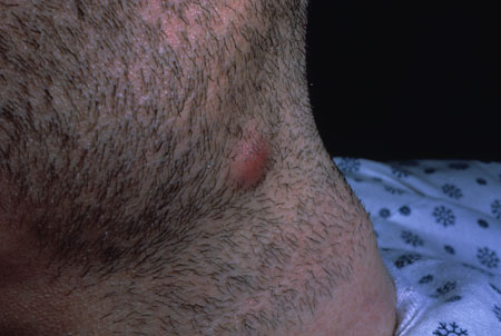 image of Kaposi sarcoma: submandibular/cervical nodule