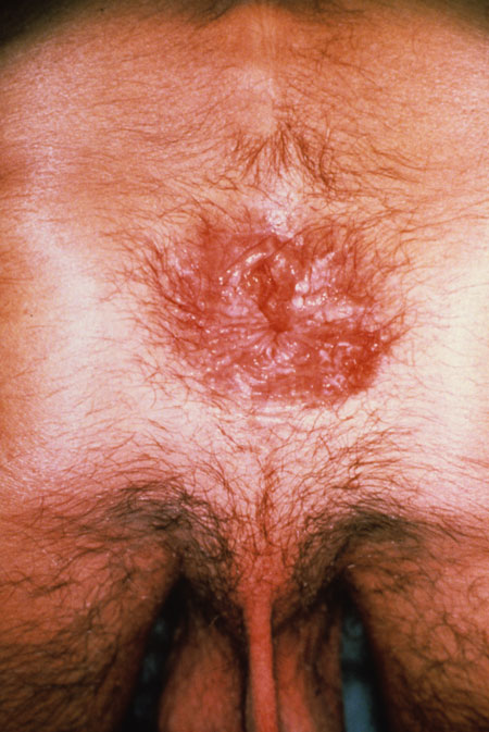 image of Herpes simplex: perianal