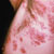 thumbnail image of Herpes zoster