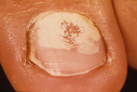 image of Onychomycosis