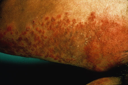 image of Candidiasis