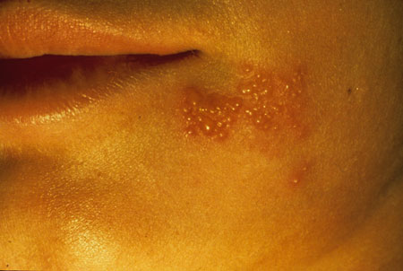 image of Herpes simplex
