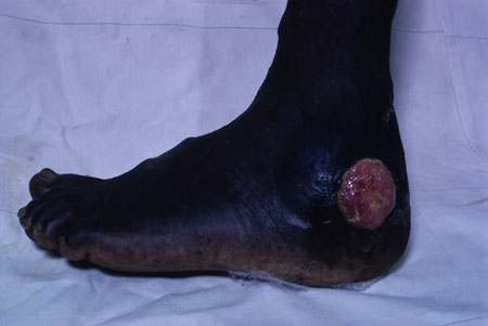 image of Kaposi sarcoma: foot