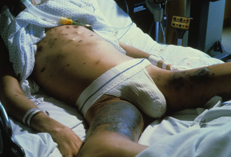 image of Kaposi sarcoma: inner thigh, chest, arm