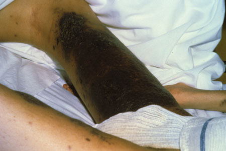 image of Kaposi sarcoma: legs