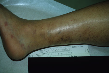 image of Kaposi sarcoma: lesions after treatment