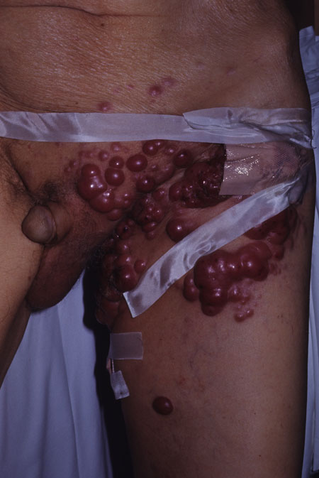image of Kaposi sarcoma