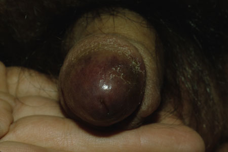 image of Kaposi sarcoma: penis