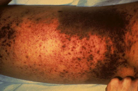 image of Kaposi sarcoma: leg with edema