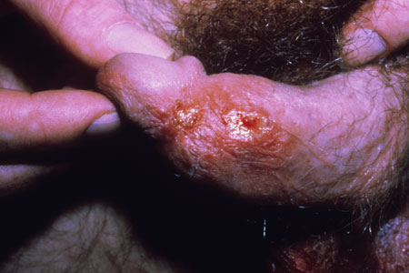 Male Herpes Symptoms: Do you have Male Genital Herpes?