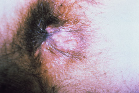image of Herpes simplex: perianal